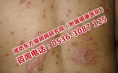男性銀屑病怎么治療理想的快