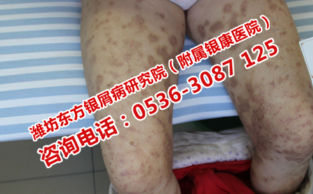 中醫治療牛皮癬抗復發嗎