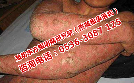牛皮癬常年患病怎么治療
